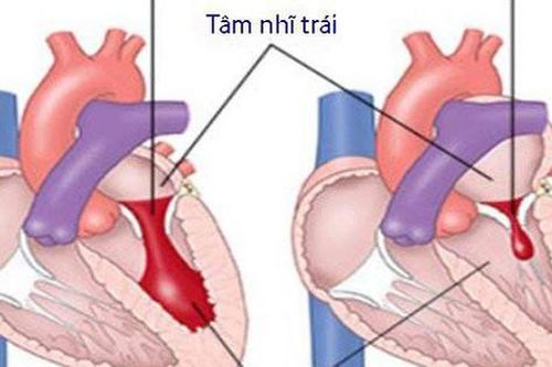 Hẹp van hai lá: Nguyên nhân, biểu hiện, cách điều trị và phòng bệnh