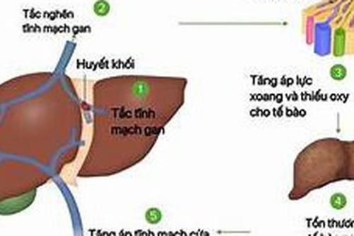 Các thuốc điều trị Hội chứng Budd-Chiari