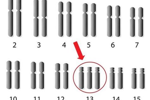 6 câu hỏi thường gặp về hội chứng Patau