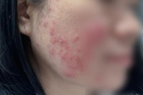 Tin kem trị mụn 'thiên nhiên' trên TikTok, nữ sinh Hà Nội phải cầu cứu bác sĩ