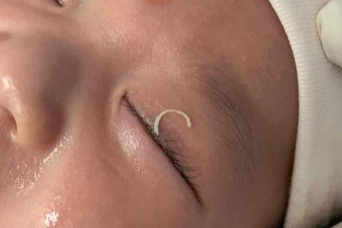 Hi hữu: Mẹ cắt móng tay văng vào mắt con 2 tháng tuổi