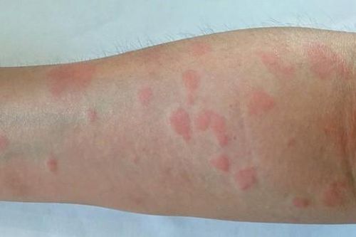 Lupus ban đỏ: Nguyên nhân, triệu chứng, cách phòng ngừa và điều trị