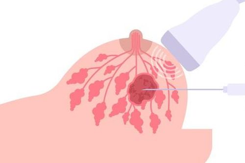 Sarcoma mạch máu: Ung thư hiếm gặp nhưng nguy hiểm