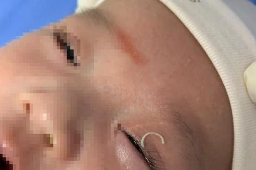 Hy hữu: Mẹ cắt móng tay khiến dị vật rơi vào mắt con 2 tháng tuổi
