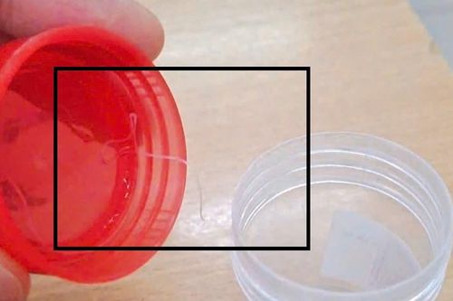 Gắp ký sinh trùng dài gần 10cm trong mắt người bệnh