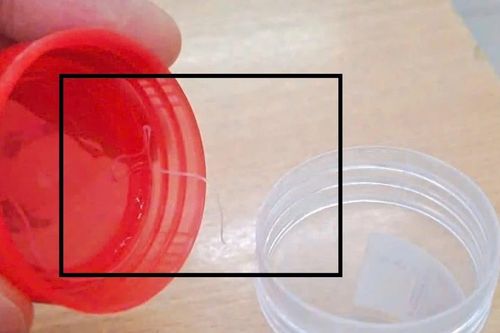 Người phụ nữ có ký sinh trùng dài gần 10cm trong mắt