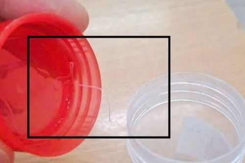 Người phụ nữ mắc ký sinh trùng dài gần 10 cm trú ẩn trong mắt