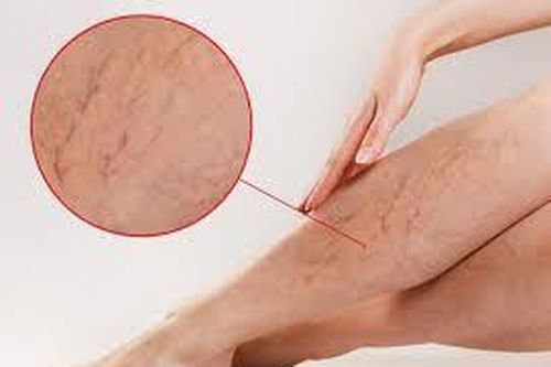 Bị suy giãn tĩnh mạch có hiến máu được không?