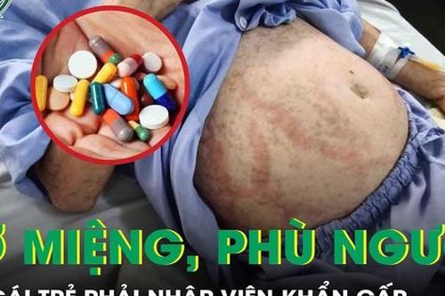Uống thuốc đau răng, thuốc cảm, cô gái trẻ lở loét vùng sinh dục, sưng phù toàn thân