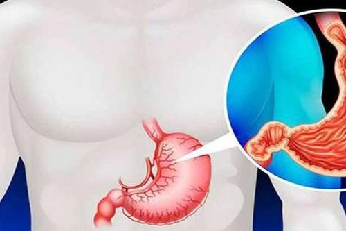 Hội chứng Dumping: Nguyên nhân, biểu hiện, cách điều trị và phòng bệnh