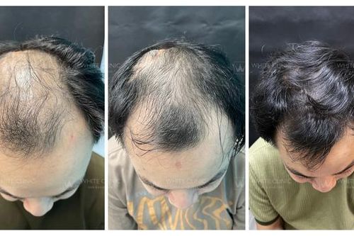 Xu hướng điều trị rụng tóc mới năm 2025