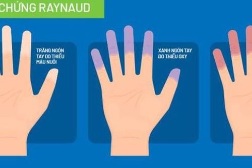 Bài tập nào tốt cho người mắc Hội chứng Raynaud?