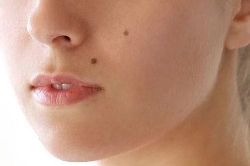 Vì sao con người lại có nốt ruồi? Bí ẩn nhỏ bé trên làn da tiết lộ điều gì về cơ thể bạn