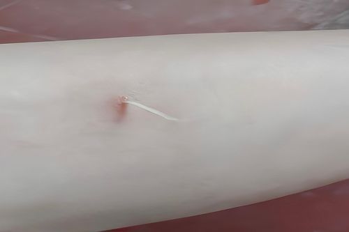 Nâng cao cảnh giác và phòng ngừa bệnh giun rồng
