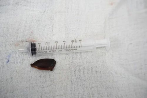 Ho kéo dài suốt tháng, cụ bà phát hiện hạt hồng xiêm nằm sâu trong phế quản
