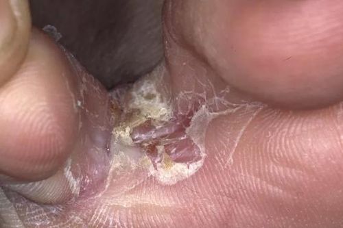 6 cách chữa nước ăn chân (nấm chân)
