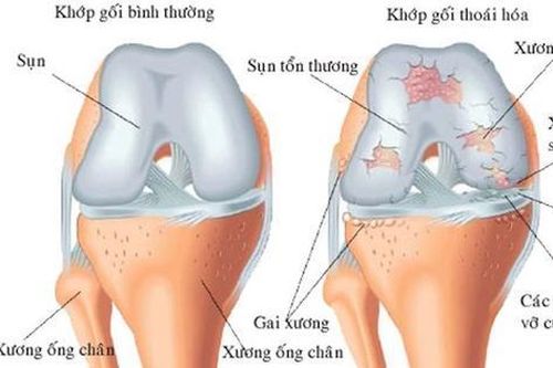 Người bệnh thoái hóa khớp gối tập luyện thế nào cho phù hợp?