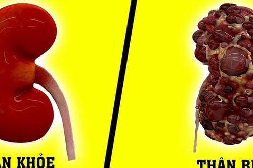 4 thói quen gây hỏng thận nhanh nhất cần thay đổi ngay