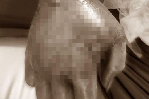 Người đàn ông bị hoại tử tay nghiêm trọng vì một việc mà nhiều người lầm tưởng