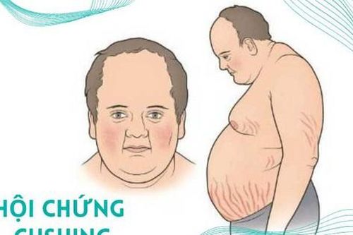 Người mắc hội chứng Cushing tập luyện thế nào có lợi cho sức khỏe?