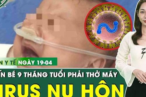 Bản Tin Y Tế 19/4: Bé 9 tháng nguy kịch phải thở máy vì nhiễm virus từ nụ hôn của người lớn