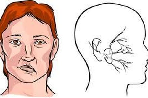 Bị méo miệng sau đột quỵ có phục hồi được không?