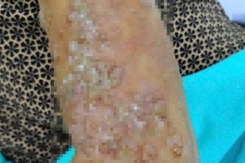 Biến chứng nhập viện sau khi bôi dầu gió chữa Zona