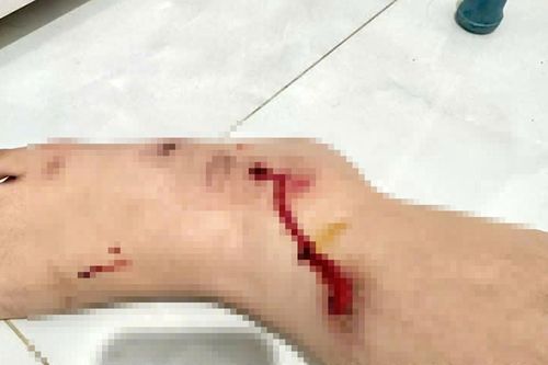 Cướp giật điện thoại, kéo lê nạn nhân trên đường một đoạn dài