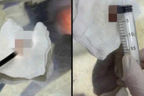Món ăn 'chua chua mặn mặn' vạn người mê này khiến cụ ông 72 tuổi nhập viện gấp