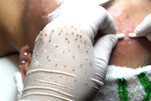 Chuyên gia lý giải vì sao những clip nặn mụn đáng sợ thu hút hàng triệu view