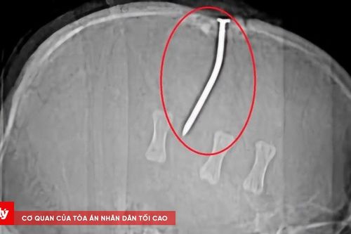 Người đàn ông bị đinh sắt 10cm đóng vào đỉnh đầu