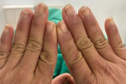 Người phụ nữ đau đớn mỗi khi chạm tay vào nước, đi khám ngỡ ngàng khi nhận kết quả