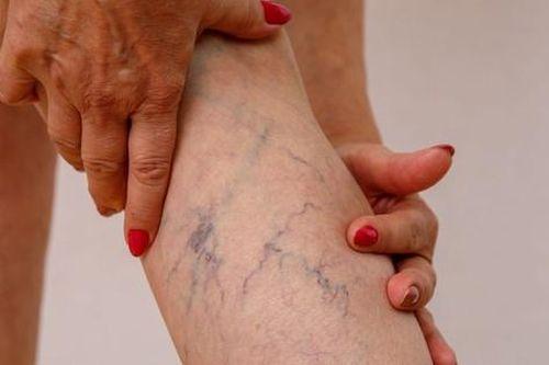 Các thuốc điều trị giãn tĩnh mạch chân