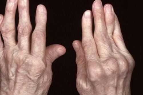 Các thuốc trị viêm khớp dạng thấp