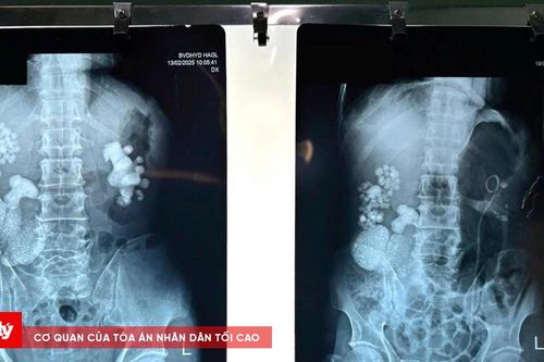 Phẫu thuật lấy hơn 100 viên sỏi trong thận người bệnh