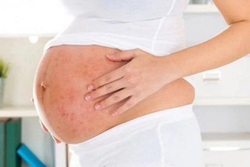 Mẹ bầu mắc sởi nguy hiểm thế nào, có lây cho thai nhi không?