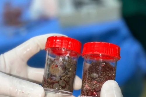 Gia Lai: Phẫu thuật nội soi cắt thận, lấy hơn 100 viên sỏi trong thận người bệnh