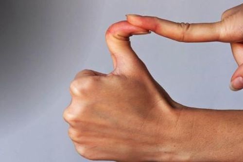Hội chứng ehlers-danlos: Nguyên nhân, biểu hiện, cách điều trị và phòng bệnh