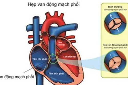 Câu hỏi thường gặp liên quan đến bệnh hẹp động mạch phổi