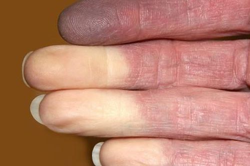 Câu hỏi thường gặp liên quan đến hội chứng Raynaud