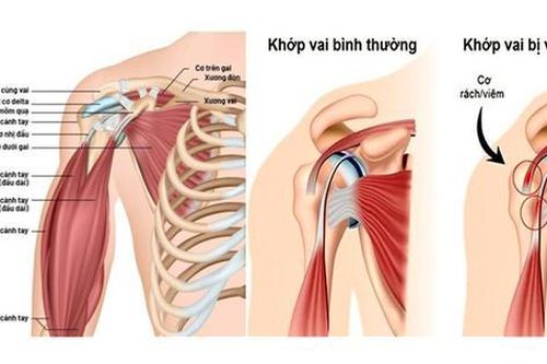 Một số thuốc dùng trị viêm quanh khớp vai