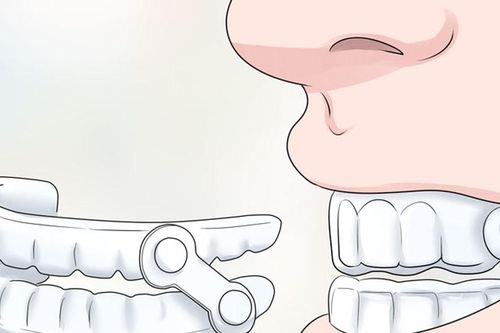 Nghiến răng là một bệnh lý