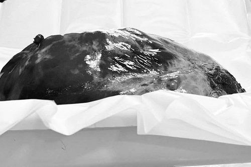 Loại bỏ khối u trung thất khổng lồ nặng 3,6kg