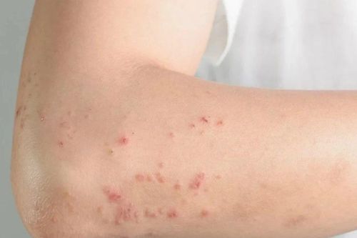 Những bệnh thường gặp trong thời điểm giao mùa Xuân - Hè
