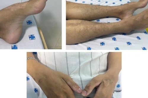Mắc bệnh hiếm gặp từ biểu hiện tê yếu tay chân, không thể chủ quan với biểu hiện sức khỏe này