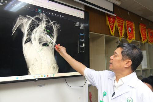 Bé gái 13 tuổi ở Hà Nội có cột sống cong hình chữ C, uốn 'như con rồng'