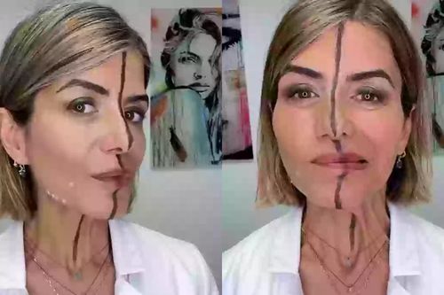 Nữ bác sĩ tiêm botox nửa khuôn mặt để chứng minh tác hại của cách làm đẹp này