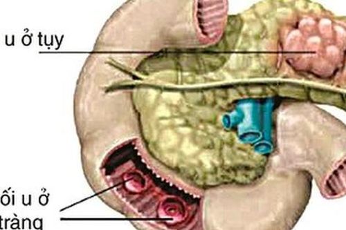 Câu hỏi thường gặp liên quan đến hội chứng Zollinger-Ellison