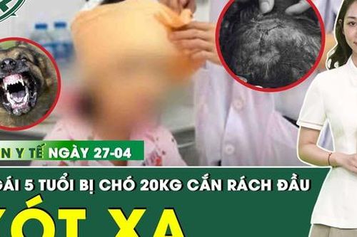 Bản tin Y tế 27/4: Bé gái 5 tuổi bị chó nhà 20 kg cắn rách đầu, mặt