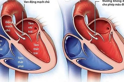Câu hỏi thường gặp liên quan đến bệnh lóc tách động mạch chủ